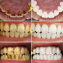Teeth Whitening Pen - SnowTooth | Buy 1 get 3 | Elegantiee
