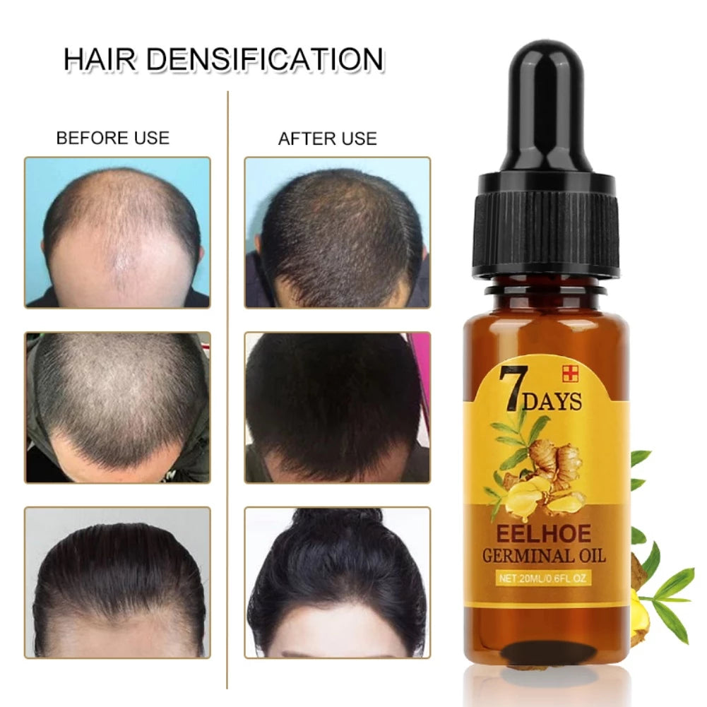Ginger Hair | Oil for Hair Growth and Treatment of Baldness | Elegantiee