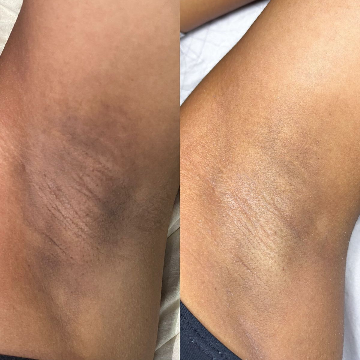 SnowBleach™️| Bleach Cream for Body Whitening