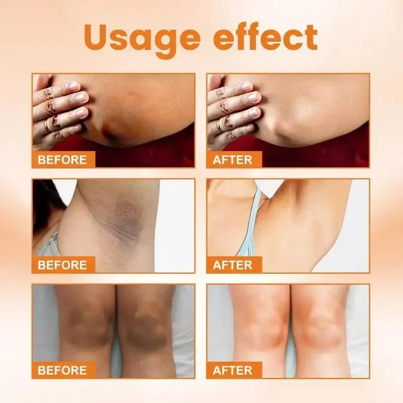 SnowBleach™️| Bleach Cream for Body Whitening